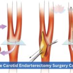 Affordable Carotid Endarterectomy Surgery Cost in India