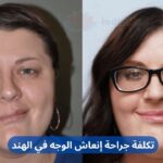 Affordable Facial Reanimation Surgery Cost in India Arabic