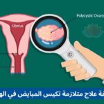 Affordable PCOS Treatment Cost in India arabic