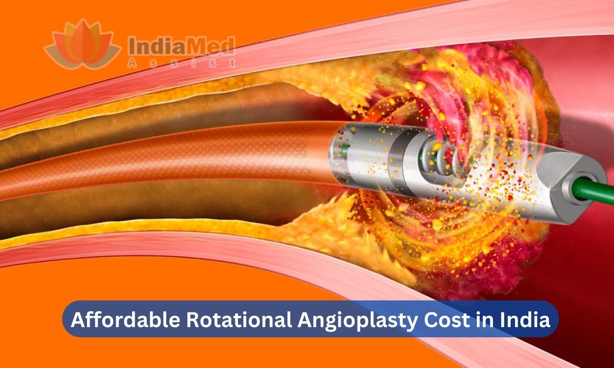 Affordable Rotational Angioplasty Cost in India
