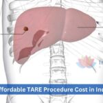 Affordable TARE Procedure Cost in India