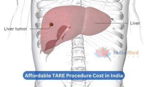 Affordable TARE Procedure Cost in India
