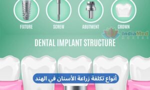 Affordable Types of Dental Implants Cost in India arabic