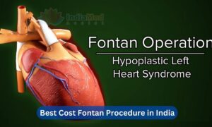 Best Cost Fontan Procedure in India