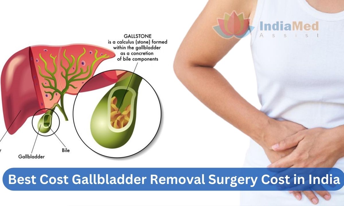 Best Gallbladder Removal Surgery Cost in India