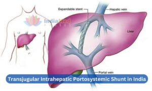 Best CostTransjugular Intrahepatic Portosystemic Shunt in India
