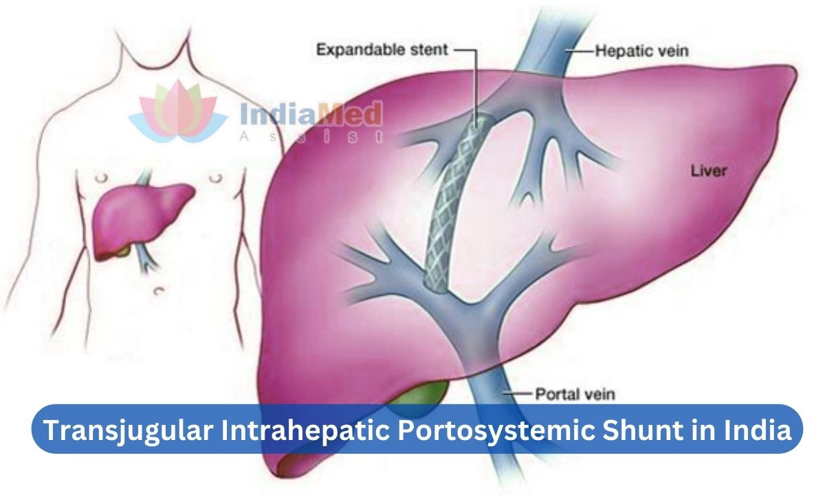 Best Cost Transjugular Intrahepatic Portosystemic Shunt in India