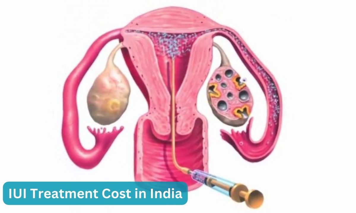 Affordable IUI Treatment Cost in India