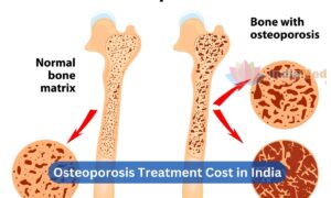 Osteoporosis Treatment Cost in India