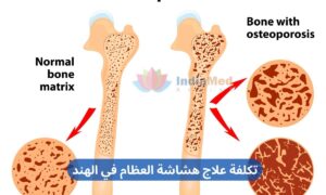Osteoporosis Treatment Cost in India arabic