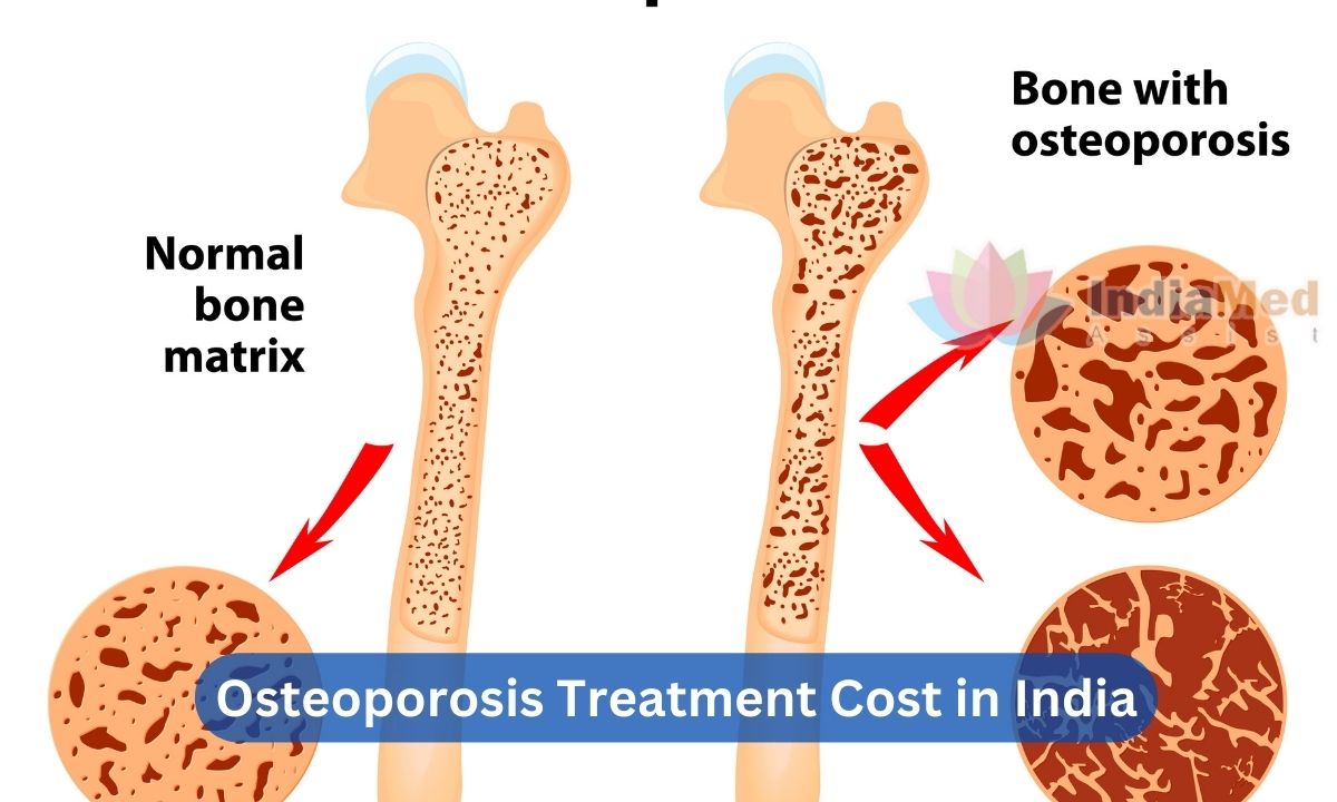 Affordable Osteoporosis Treatment Cost in India