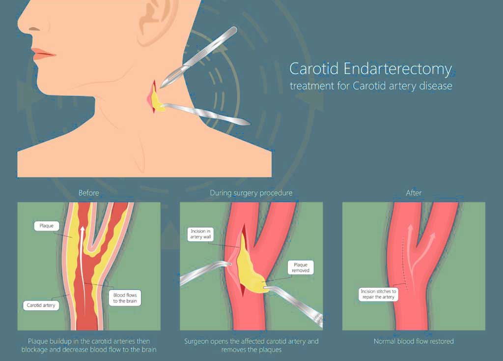 carotid endarterectomy surgery procedure