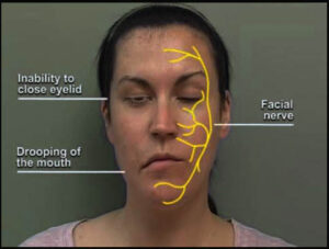 Treatment for facial paralysis in India